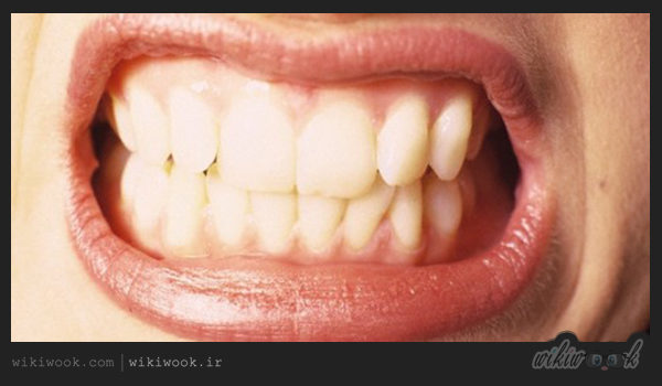 دندان قروچه در خواب چه عوارضی دارد؟ / ویکی ووک