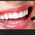 چگونه لکه های سفید روی دندان را از بین ببریم؟ / ویکی ووک