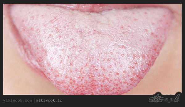 بیماری برفک دهان چیست؟ / ویکی ووک