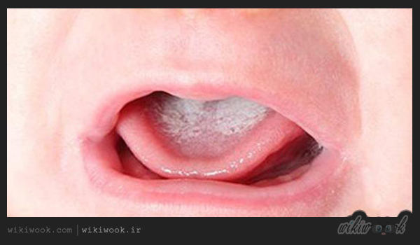 بیماری برفک دهان چیست؟ / ویکی ووک