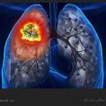 چگونه عفونت ریه را درمان کنیم؟ / ویکی ووک