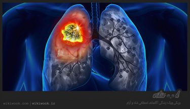 چگونه عفونت ریه را درمان کنیم؟ / ویکی ووک