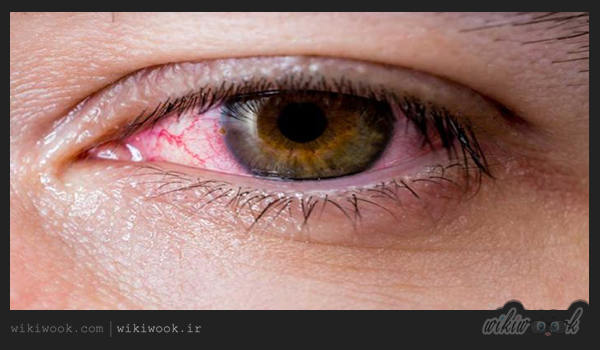 لکه های خونی چشم نشانه چیست؟ / ویکی ووک