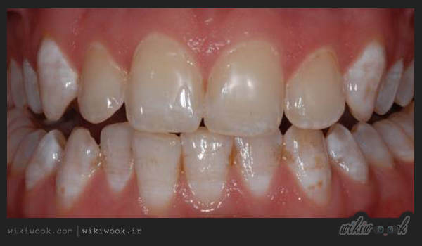 فلوروزیس دندانی چیست؟ / ویکی ووک
