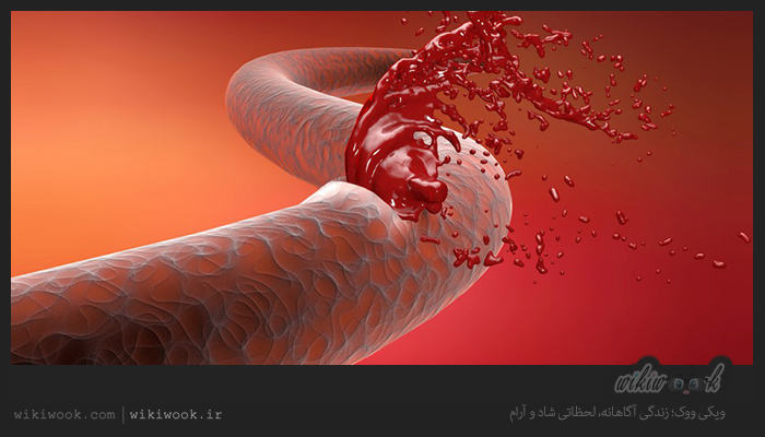 چگونه خونریزی گوارشی را درمان کنیم؟ / ویکی ووک