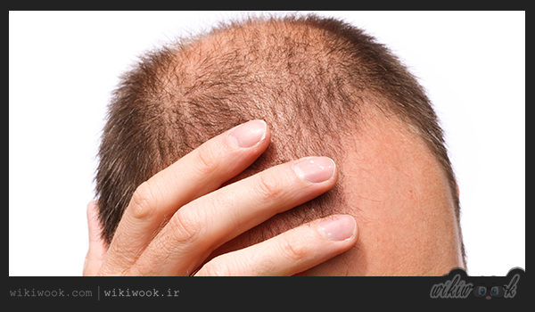 برای جلوگیری از ریزش مو چه باید کرد؟ / ویکی ووک