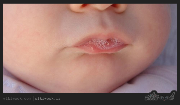 چه بیماری هایی از طریق بزاق دهان انتقال پیدا میکند؟ / ویکی ووک