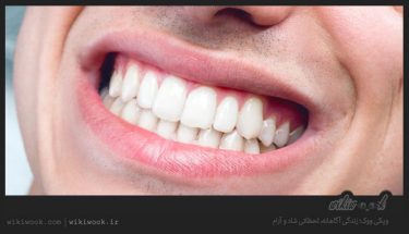 سفید کننده های طبیعی دندان